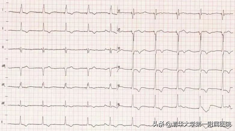 如何预防起搏器综合征,起搏器综合征危害处理