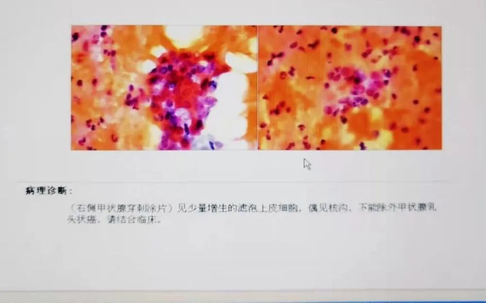 案例分享：3分钟“治愈”甲状腺乳头状癌