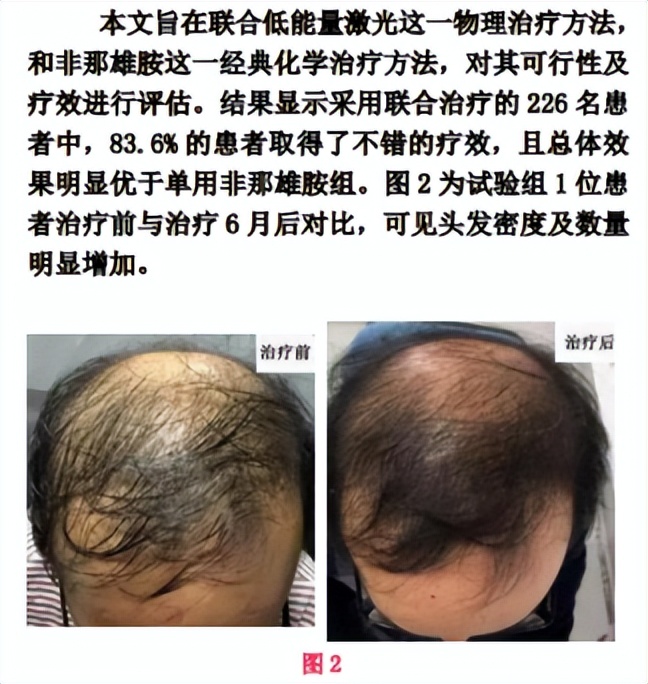 激光治疗能生发吗,三甲医院激光项目有什么最值得做