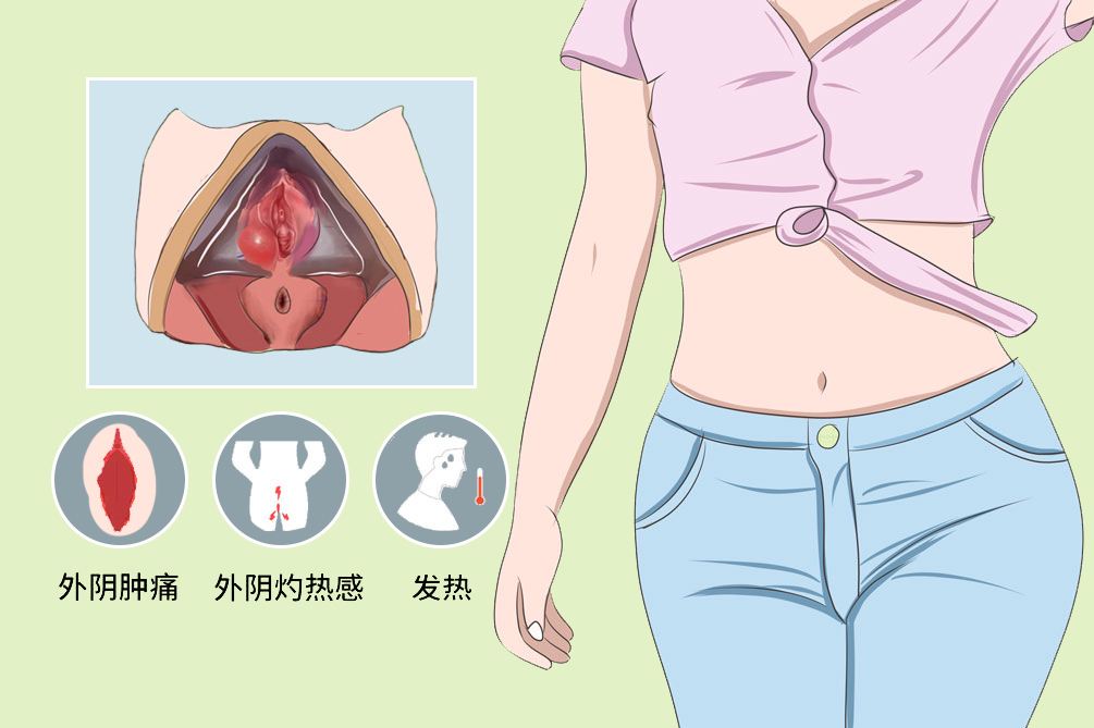 女性前庭大腺炎是什么病引起的,前庭大腺炎是什么原因造成的