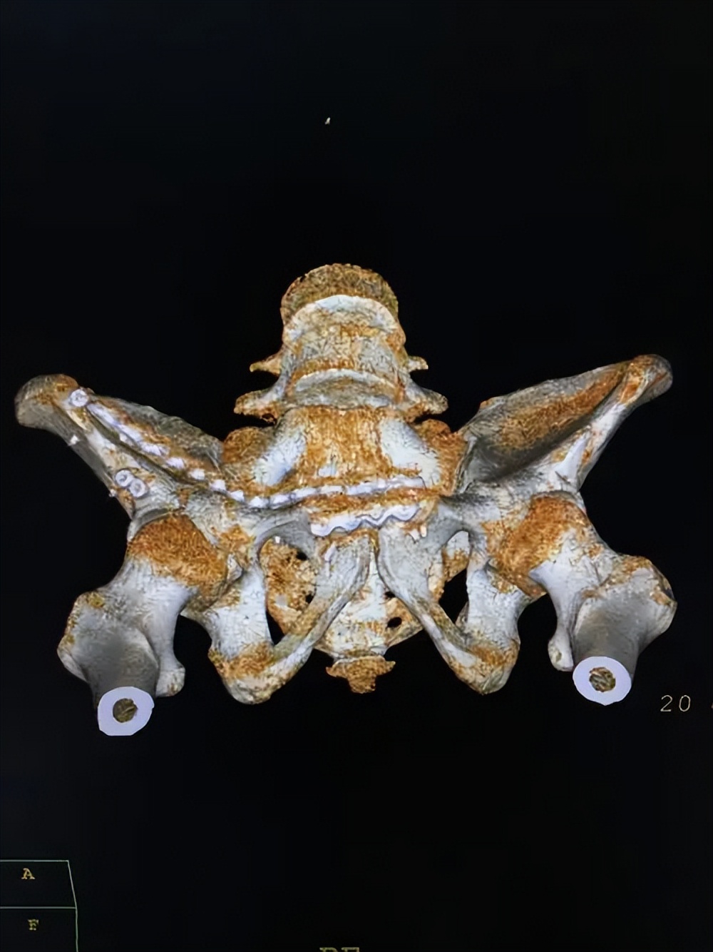 骨盆后环损伤后，新型螺钉的不同内固方法各有何优势？哪种方法好