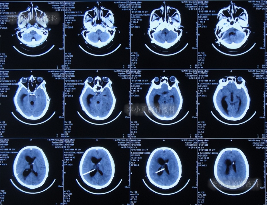 脑积水三脑室造瘘多久能恢复,脑囊虫手术后脑积水
