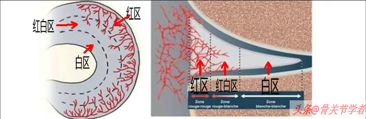半月板损伤严重的状态是什么,半月板损伤应该注意什么问题