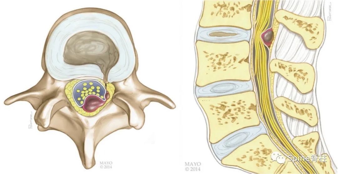 腰椎间盘突出症状表现,腰椎间盘突出症疼痛最佳止痛方法