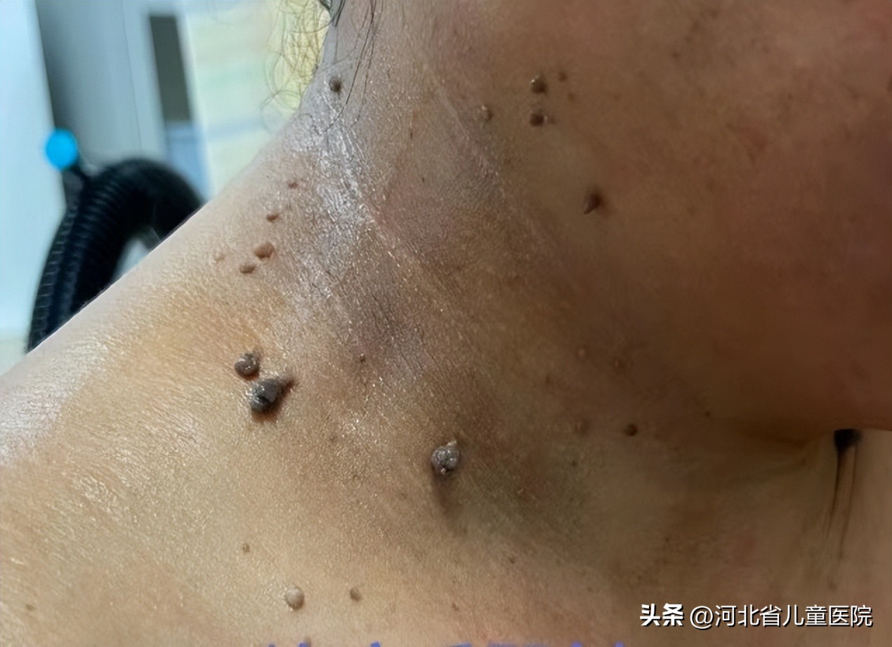 脖子上很多小肉揪图片,脖子长个肉揪揪怎么去除