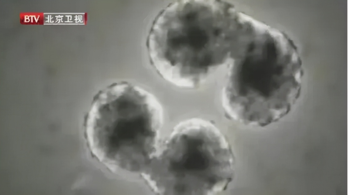 2年没复查结节竟然变成了癌症,息肉化验是癌前病变怎么办