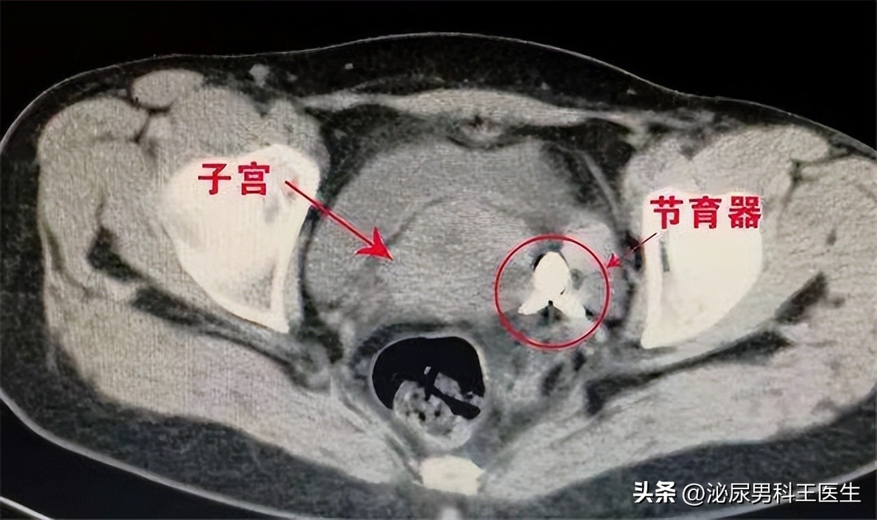 节育环多大年龄取出好取,节育环一直不摘