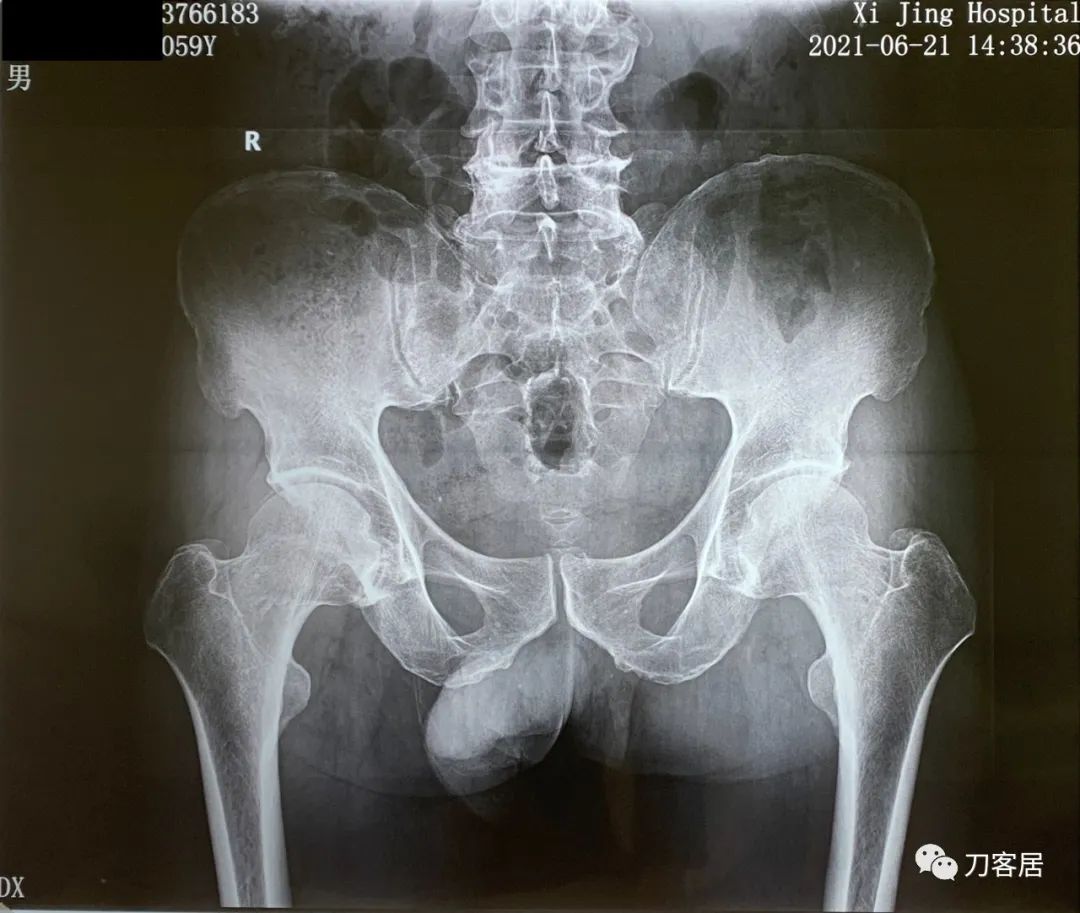 髋部疼，小腿肚胀、抽筋，折腾了5年没效果，能用阿仑膦酸钠吗？