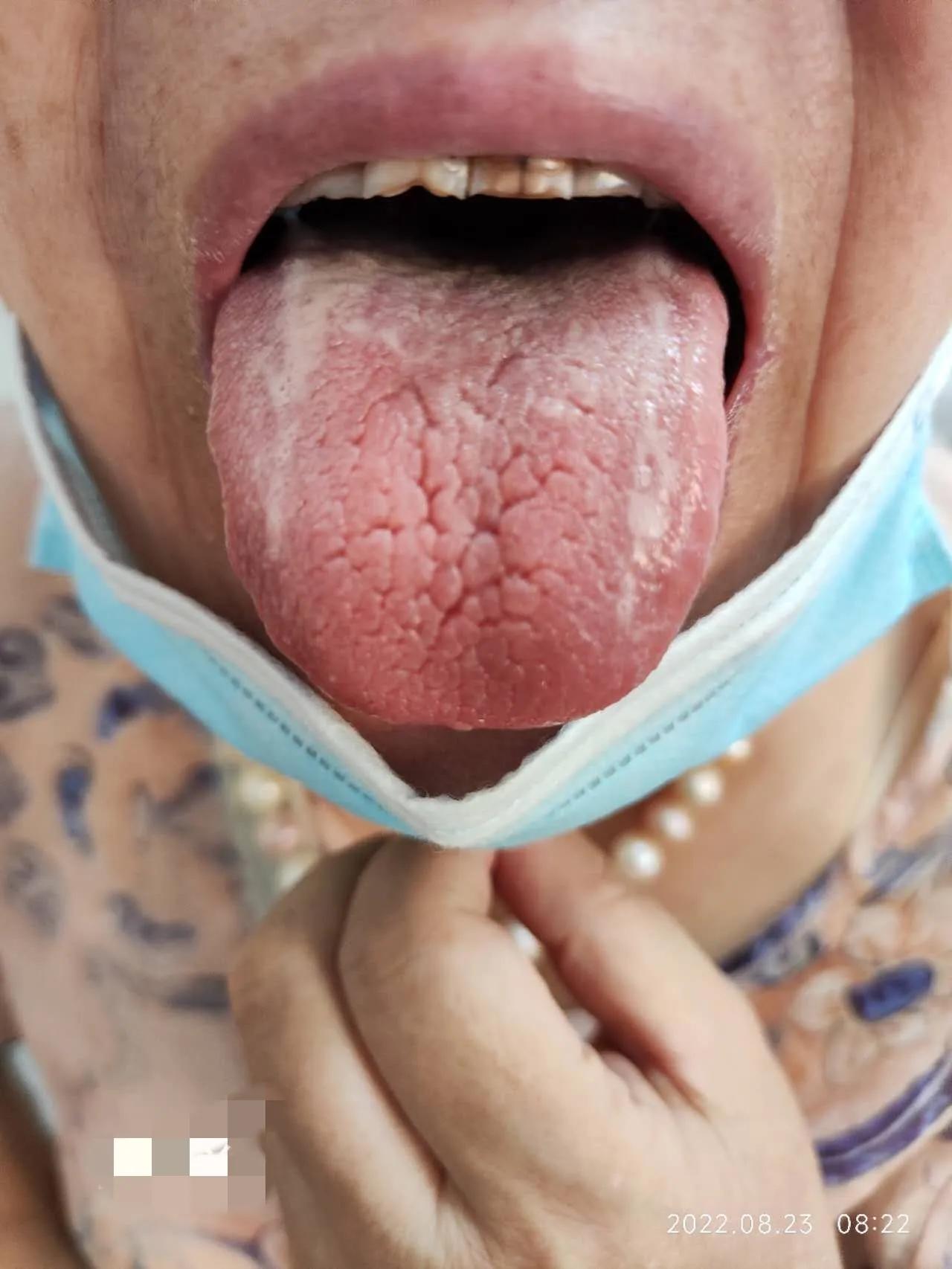 口服中药3个月，确诊5年的干燥综合征患者病情明显缓解