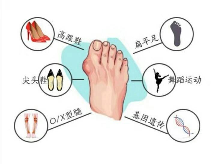 脚底板爱出脚汗怎么回事,脚底板爱紫是什么原因