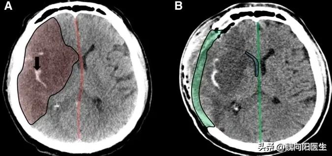 脑梗为什么要割掉神经,脑梗死为什么脑袋会疼