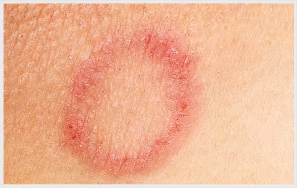 梅毒可以彻底治愈吗还会传染,梅毒可以彻底治愈吗中医