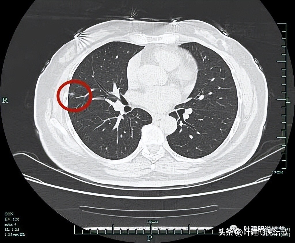 子宫内膜癌术后病灶大于二厘米,子宫内膜癌手术后一年又发现肺癌