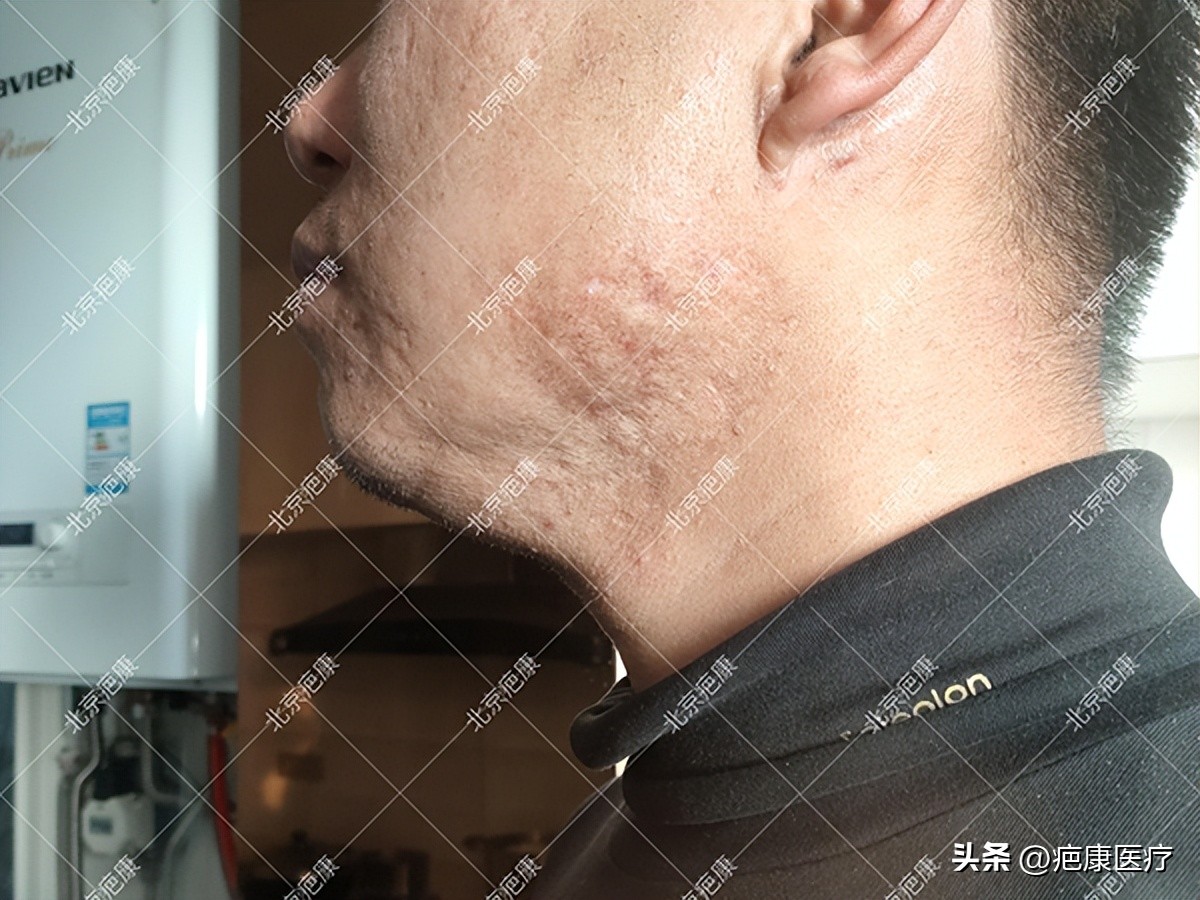 脸颊疤痕疙瘩治疗过程图,疤痕疙瘩脸颊