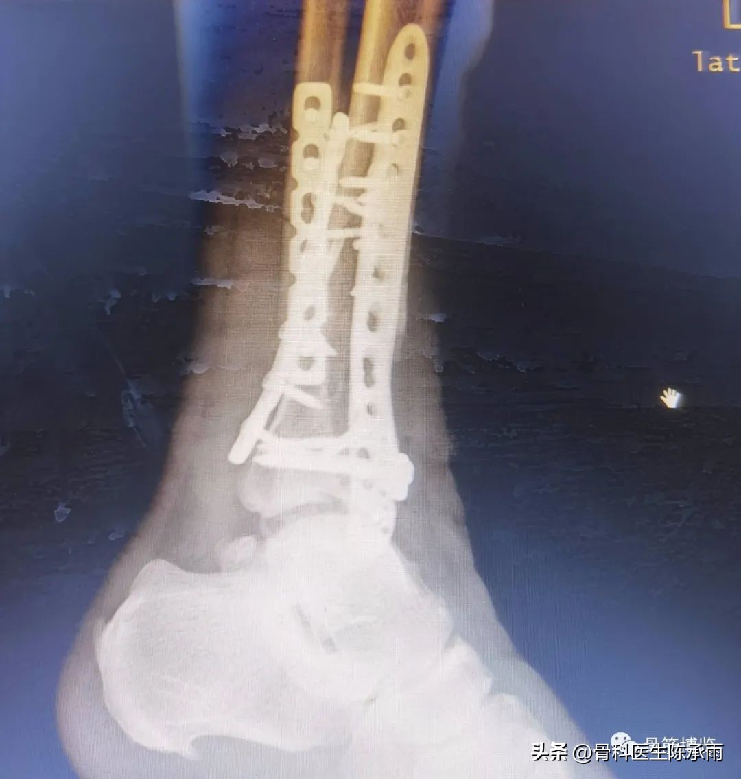 娓哥鐨摚淇,涔旀皬鐨摚淇瓒宠儗澶栦晶鐨偆缂烘崯