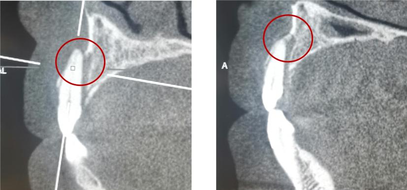 牙齿受外伤吃什么对牙好,牙齿受损伤引起牙痛怎么办