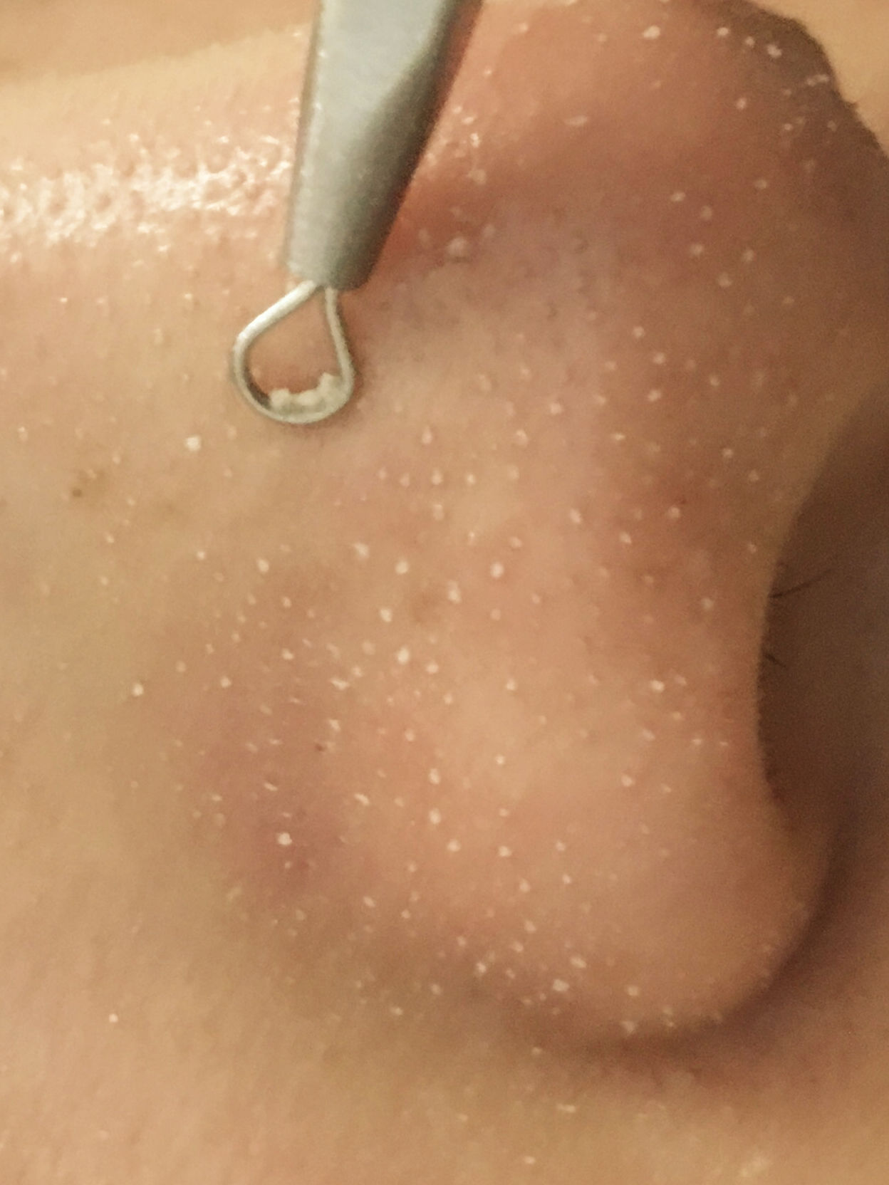 美容院护肤去黑头正常价格,小气泡去黑头美容仪器