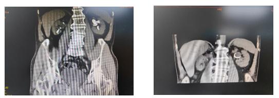 无创纳米手术,结石手术无创是怎样的