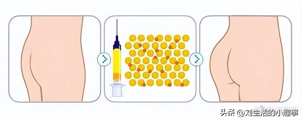 网红丰臀手术死亡,隆臀手术死亡的女子
