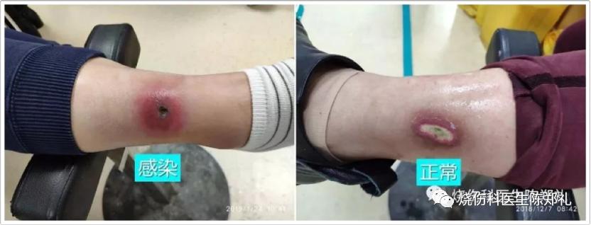 小孩不听话进厨房被烫伤,小朋友被油锅烫伤怎么办