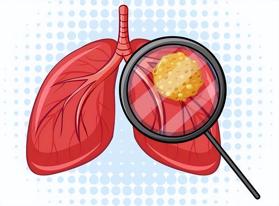 后背肩膀疼痛一定是癌症引起的吗,癌症导致的肩膀疼痛怎么缓解