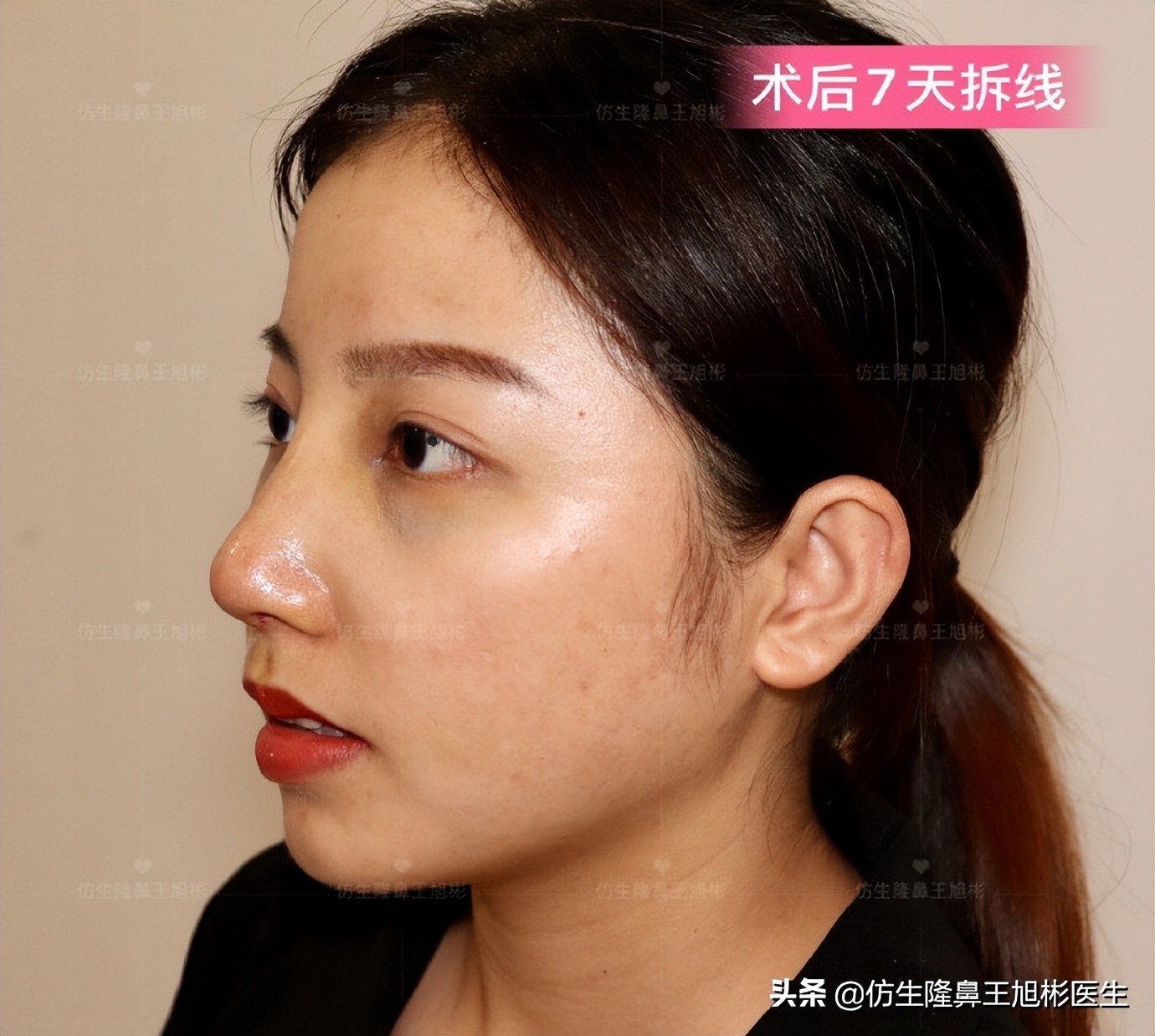 手术鼻头增厚能用什么方法弄,大鼻头高鼻梁缩小手术案例