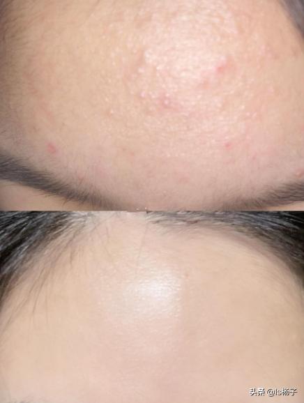 额头上的闭口粉刺怎么去除小妙招,额头长闭口粉刺的正确消除方法