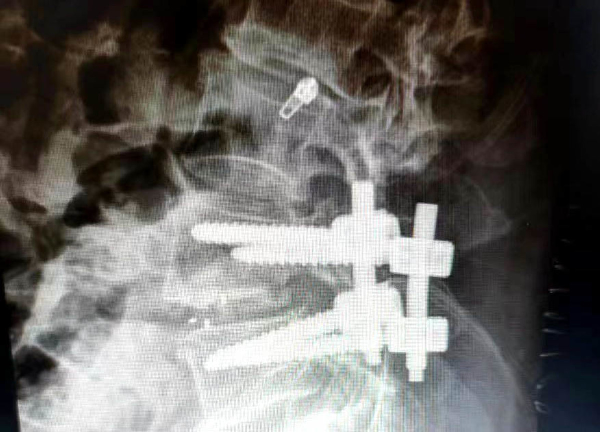 八旬老人腰痛能不能根治,80岁老人神经性腰疼可以治愈吗