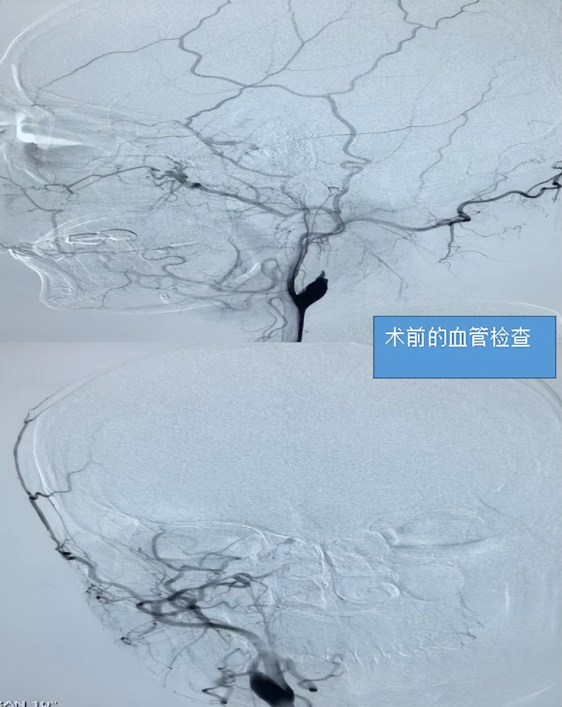 血管缝合200多针,脑血管搭桥手术2011年的成功率