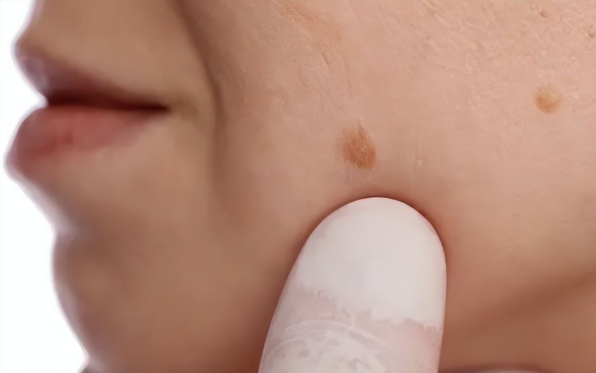 身上这3个地方长痣癌症可能来了,身上三个地方出现痣说明是癌变