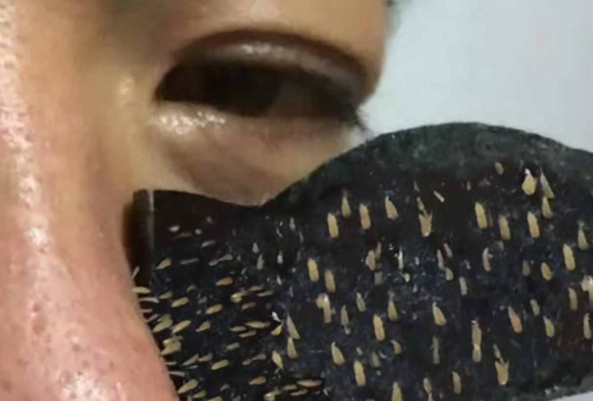 女生有黑头的正确消除方法,生活妙招去黑头3招告别草莓鼻