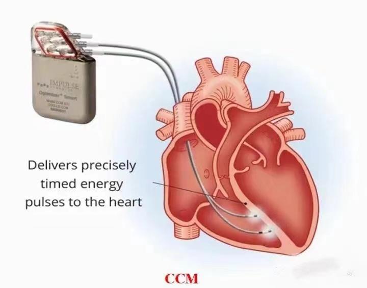 ccm植入式心脏收缩力调节器怎么样,心脏ccm调节器植入后可以用几年