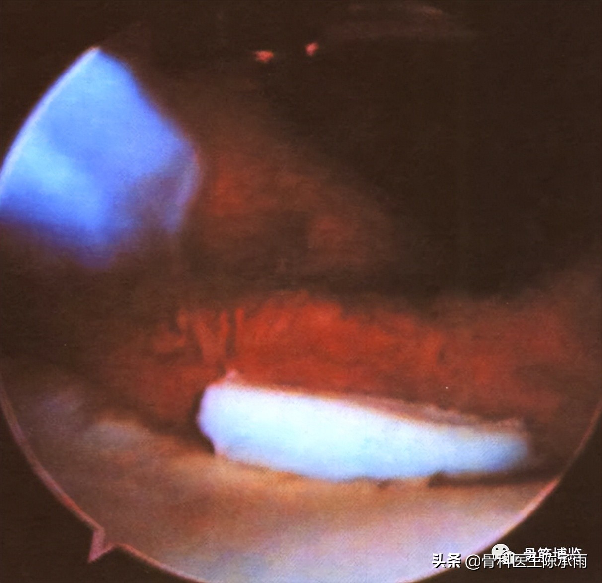 膝关节2度损伤需要做关节镜吗,膝关节常见损伤的检查方法