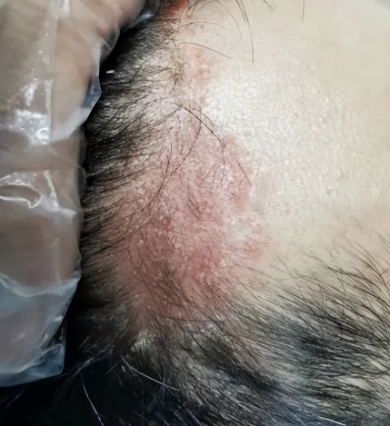 头皮有很多红疙瘩是脂溢性皮炎吗,脂溢性皮炎头皮是由什么引起的