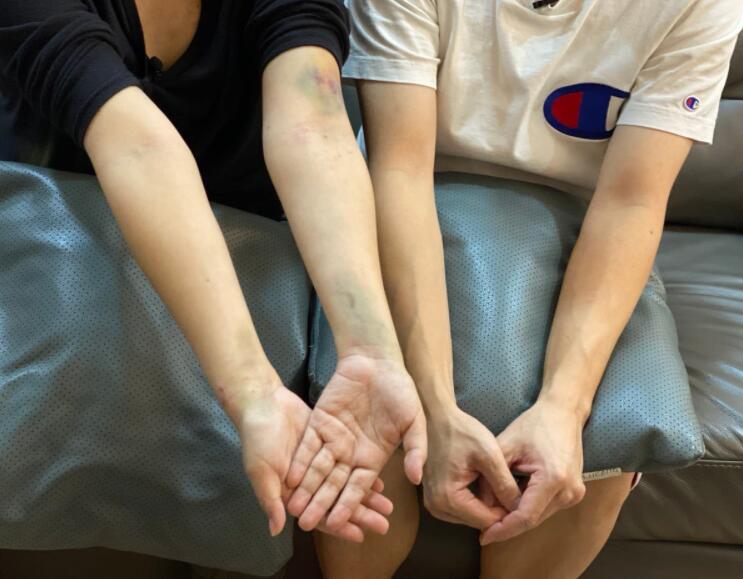 新加坡胎死腹中孕妇曝照：输血输到手淤青、一句“不能”彻底破防