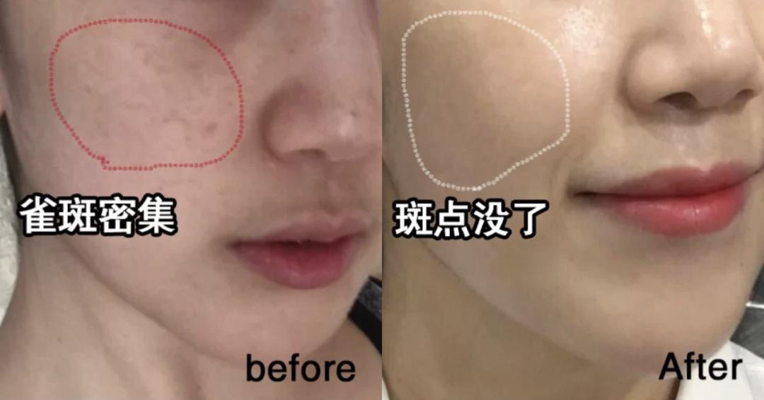 科颜氏美白淡斑精华去痘印,科颜氏美白淡斑精华液去痘印