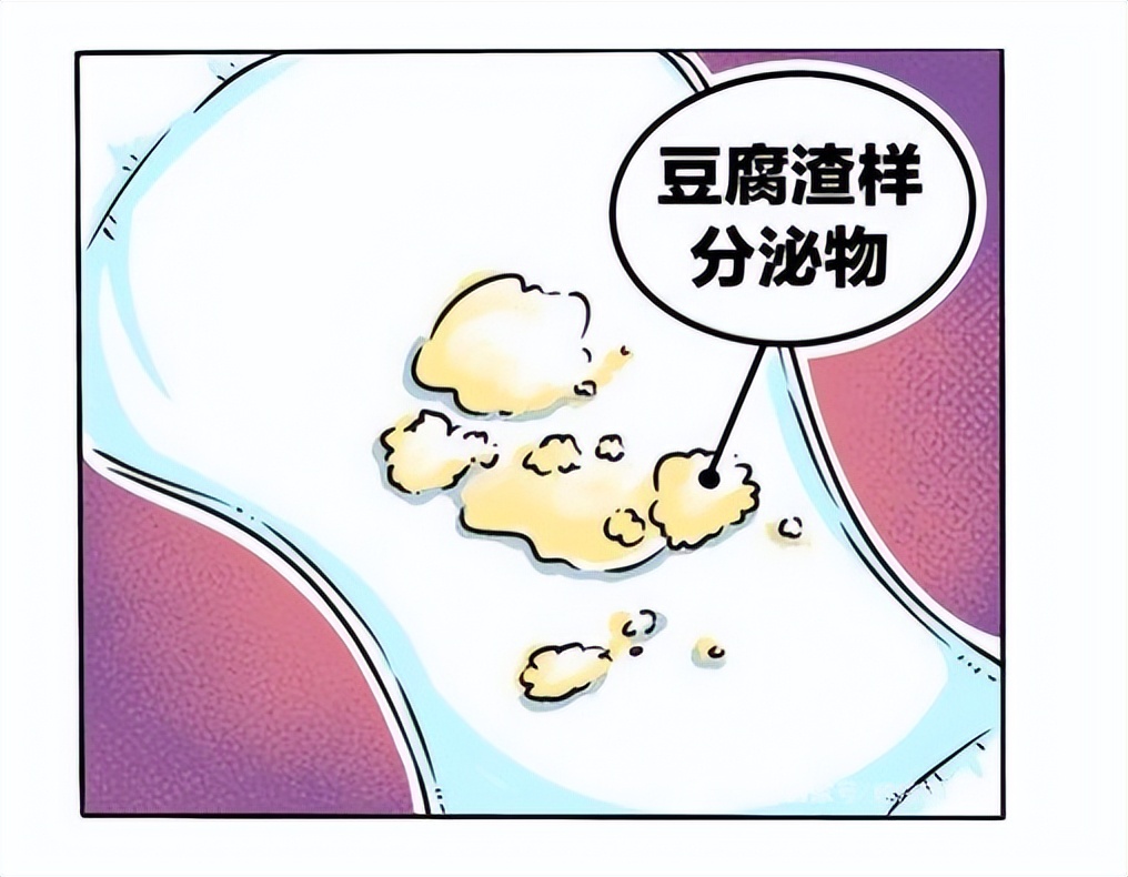 分泌物像豆腐渣还瘙痒用什么药,豆腐渣样分泌物伴有瘙痒用什么药