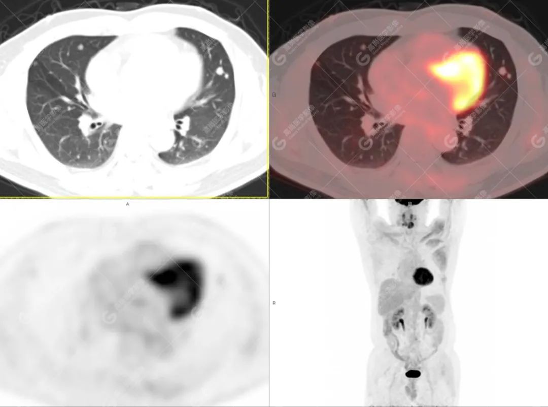 肺部结节确诊是癌如何治疗,肺结节疑似早期恶性肿瘤