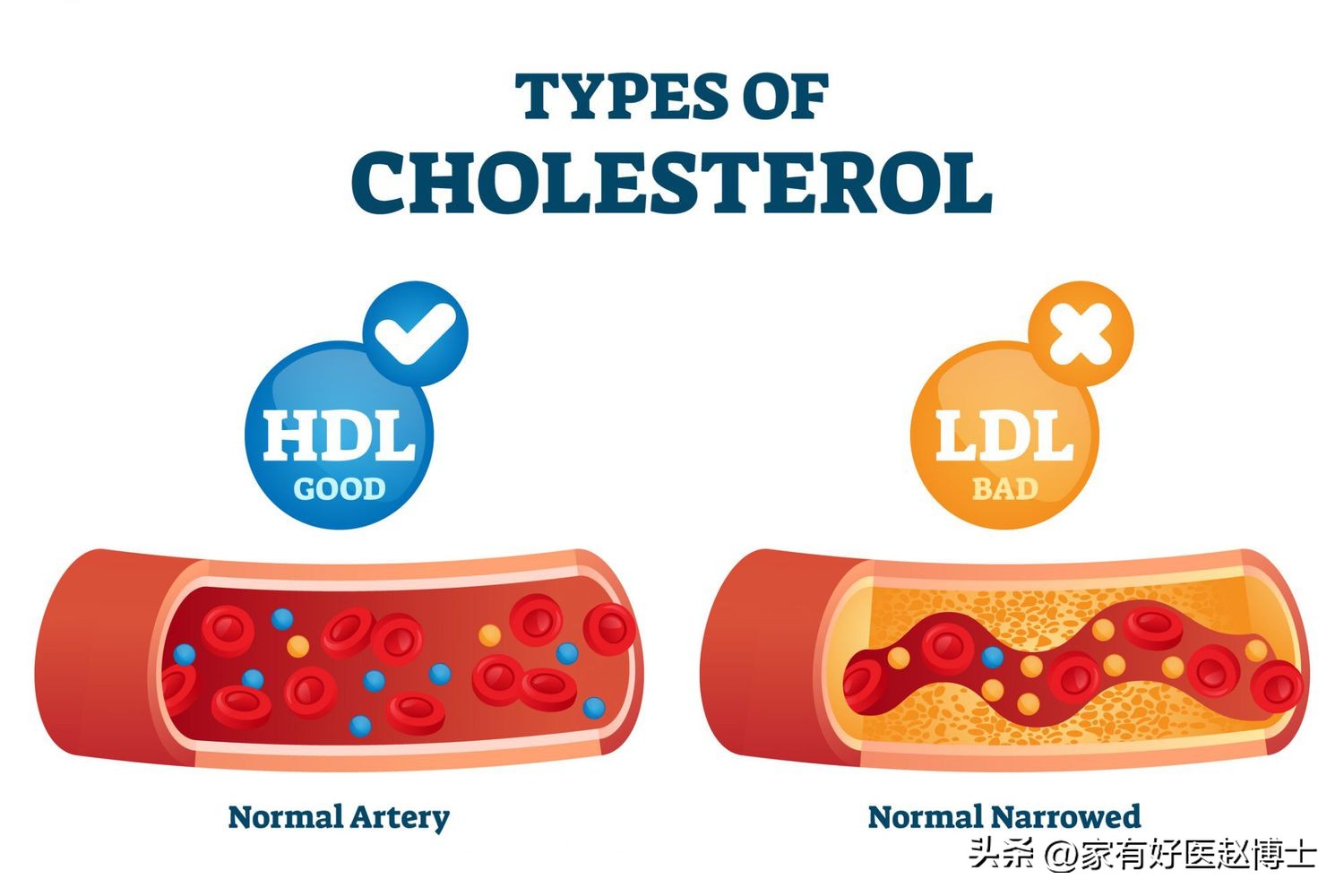 高密度胆固醇hdl偏低应该如何饮食,高密度脂蛋白胆固醇hdl偏低0.85
