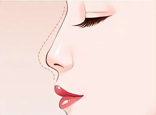 市面上有哪些隆鼻方式,现在的隆鼻技术都是做的微创吗