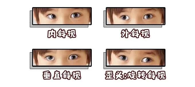 孩子斜视手术后还是斜视,斜视弱视可以做斜视手术吗