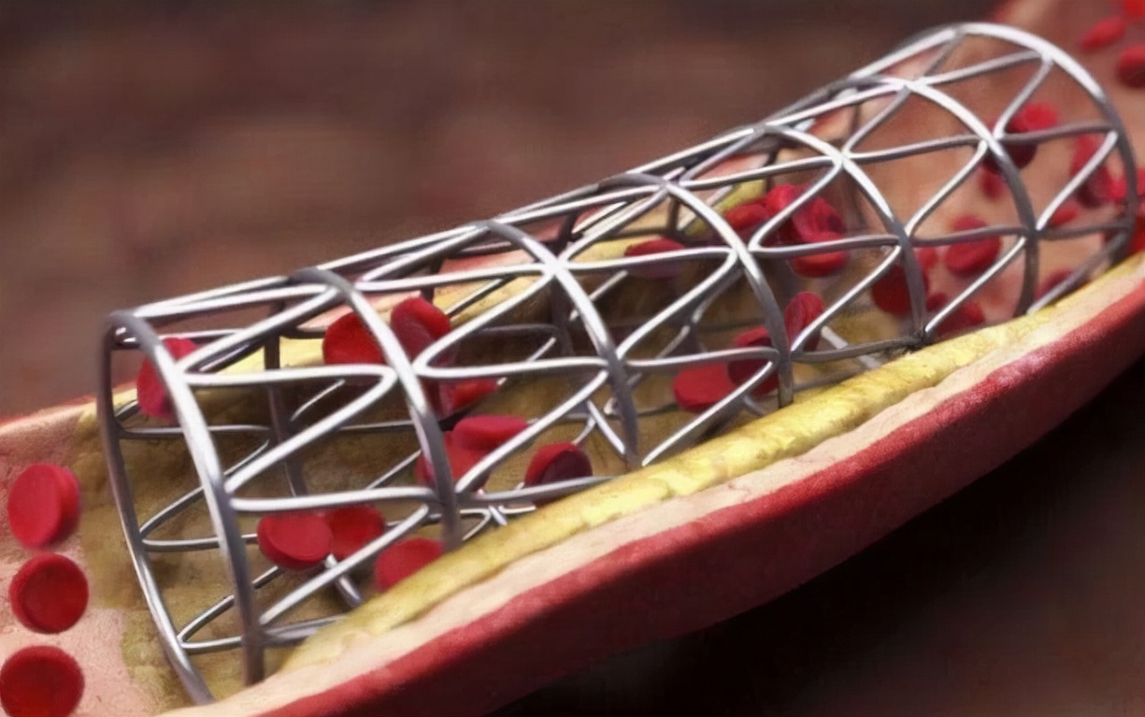 心脏支架到底害人还是救人,心脏支架到底是救人还是坑人