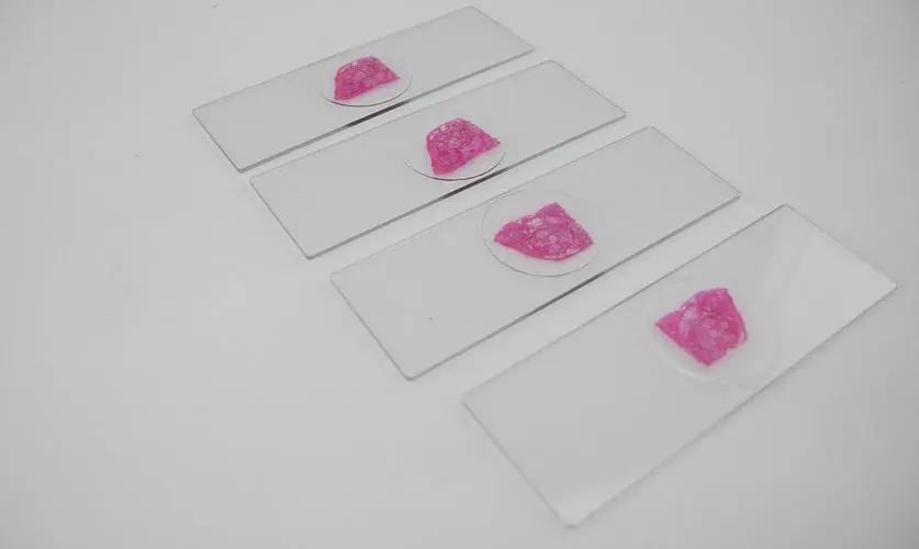 男子被确诊癌症暴瘦40斤,什么病被误诊为胰腺癌的几率大