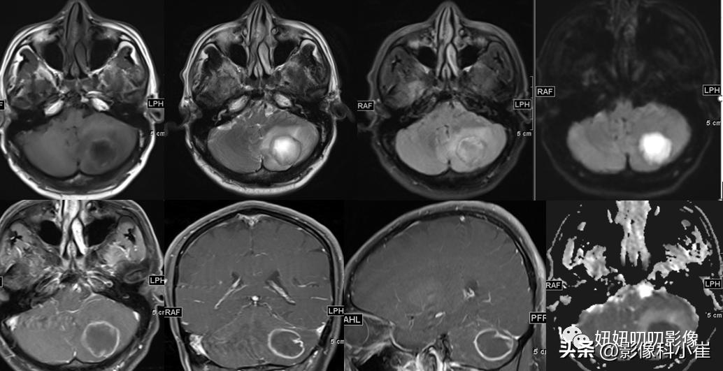 脑部局灶性强化是什么意思,脑部环形强化灶是什么意思