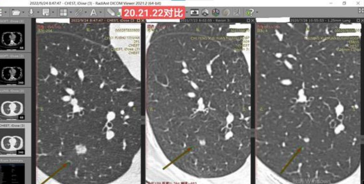 7mm肺结节恶性的怎么办,7mm实性肺结节危险程度