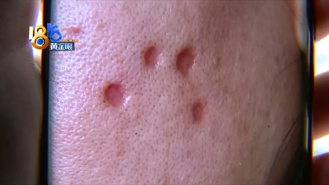 顾客说点痣后留坑怎么回复,激光点痣太深留下坑