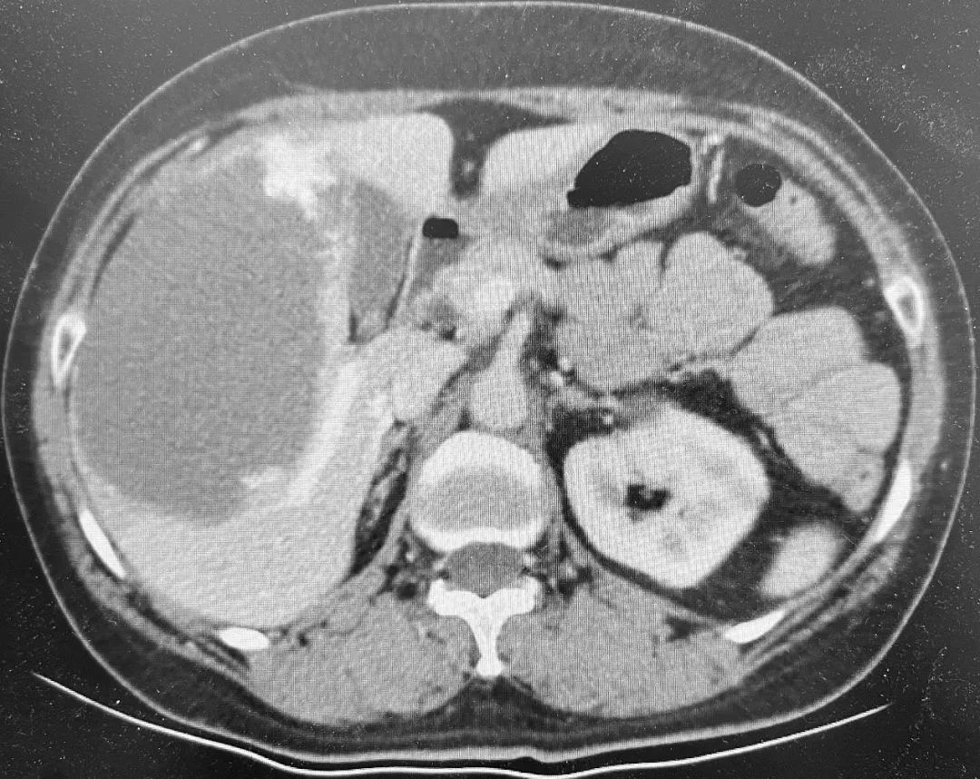 多发肝血管瘤介入治疗,多个肝血管瘤治疗