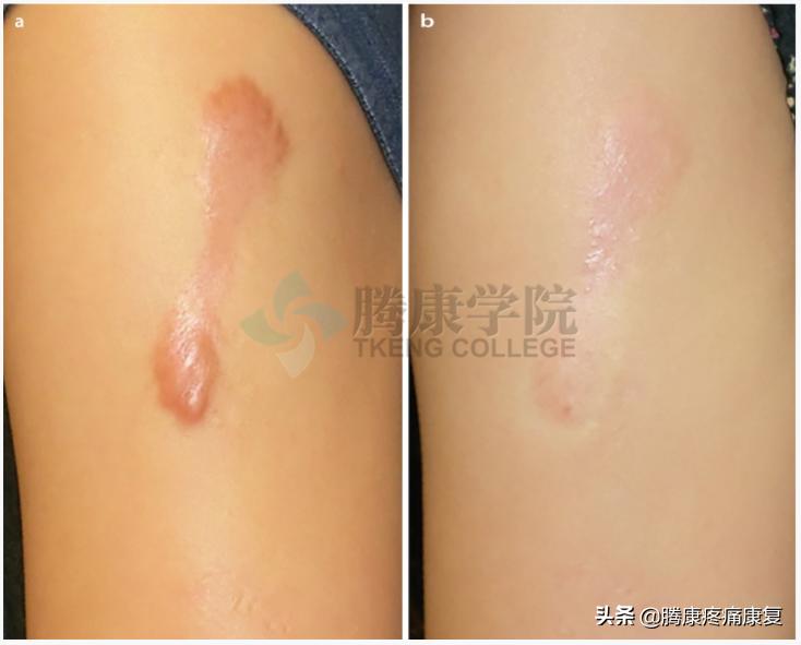 增生性瘢痕和瘢痕疙瘩的鉴别诊断,皮质类固醇贴
