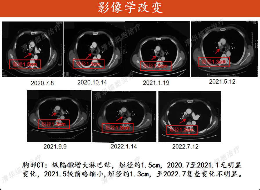 膀胱癌，两年内3次手术2次化疗，怎样才能彻底解决问题