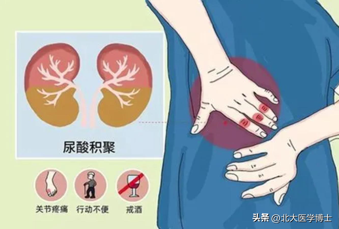 他，41岁，痛风肾急性发作，肌酐165，尿蛋白++，化湿降浊汤治验